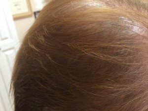 microneedling for hair loss, Hair Restoration NY with Micro-Needling and PRP