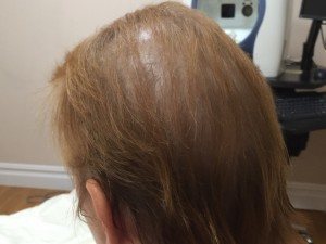 microneedling for hair loss, Hair Restoration NY with Micro-Needling and PRP