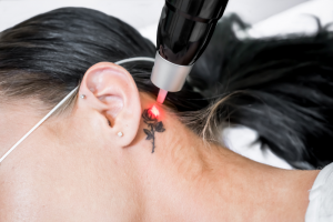 how does laser tattoo removal work