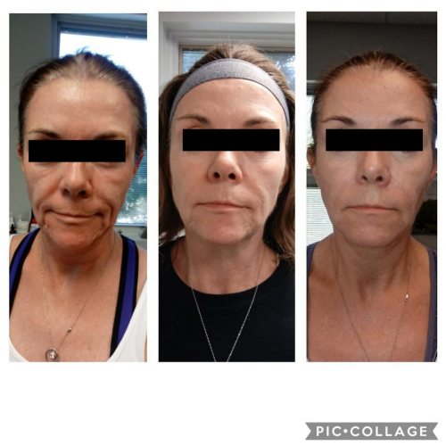 Microneedling Case 1