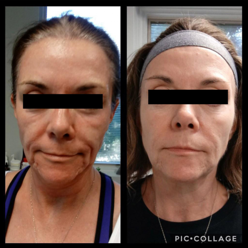 Microneedling Case 1