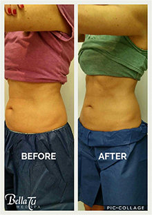 CoolSculpting Case 1