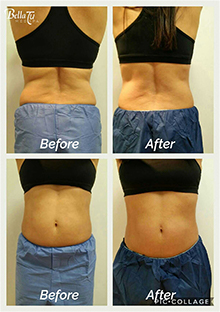CoolSculpting Case 2