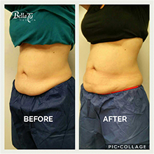 CoolSculpting Case 3