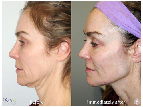 Face Procedures Case 6