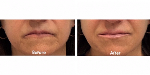 Liquid Facelift Case 3