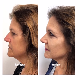 Liquid Facelift Case 1