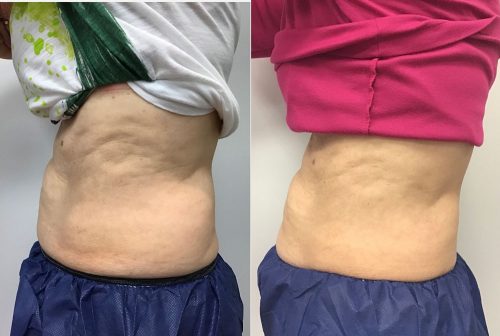 CoolSculpting Case 4