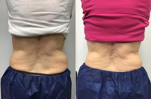 CoolSculpting Case 4