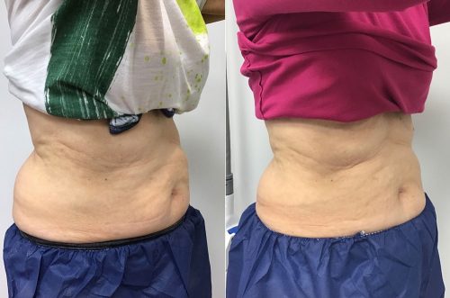 CoolSculpting Case 4