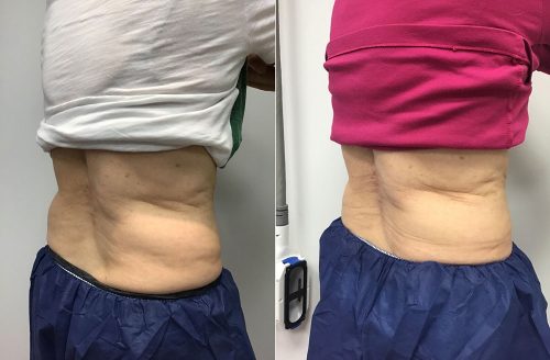 CoolSculpting Case 4