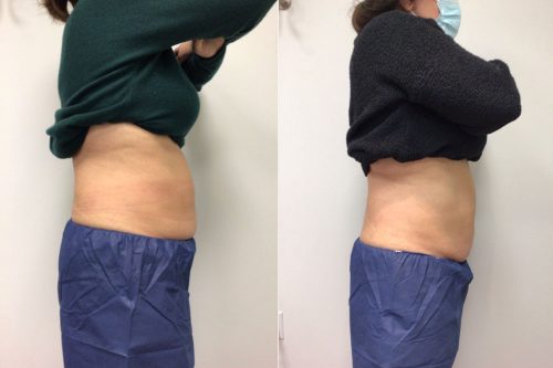 CoolSculpting Case 5