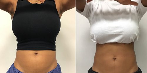 CoolSculpting Case 6