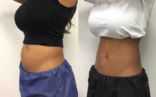 CoolSculpting Case 6