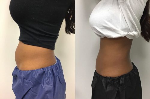 CoolSculpting Case 6