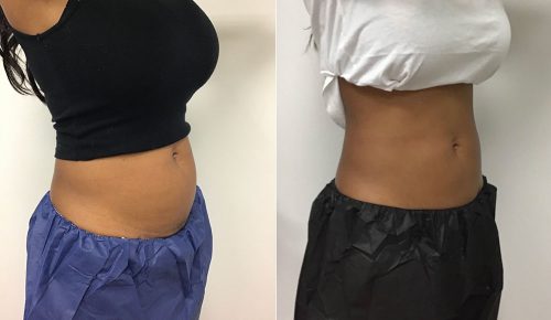 CoolSculpting Case 6