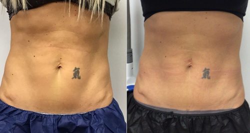 CoolSculpting Case 7