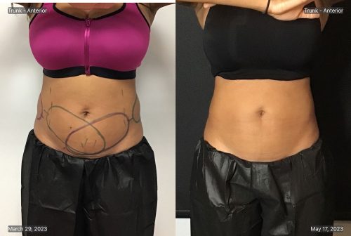 CoolSculpting Case 8