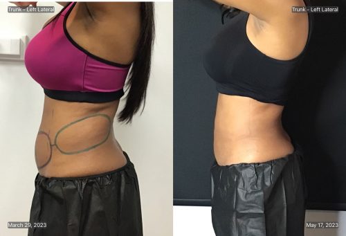 CoolSculpting Case 8