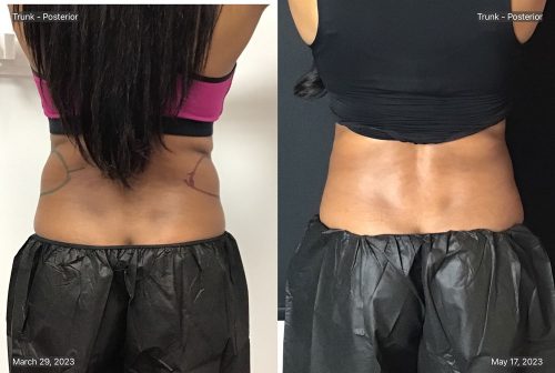 CoolSculpting Case 8