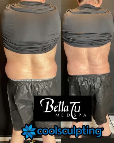 CoolSculpting Case 9