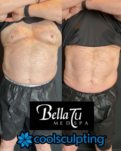 CoolSculpting Case 9