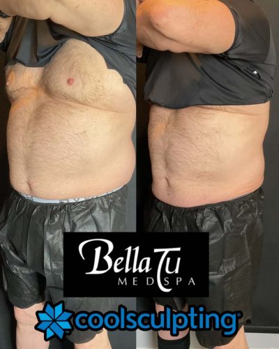 CoolSculpting Case 9