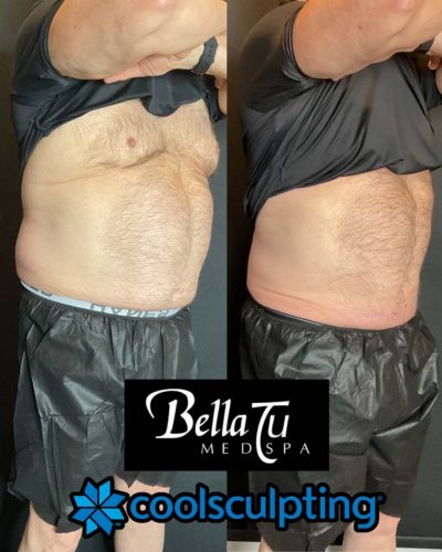 CoolSculpting Case 9